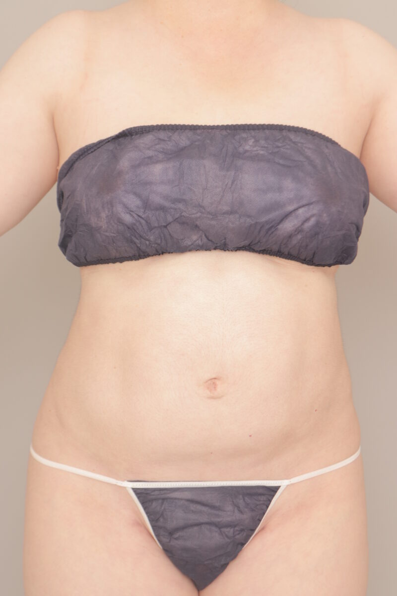 ベイザー脂肪吸引（半年経過：47）の術後写真