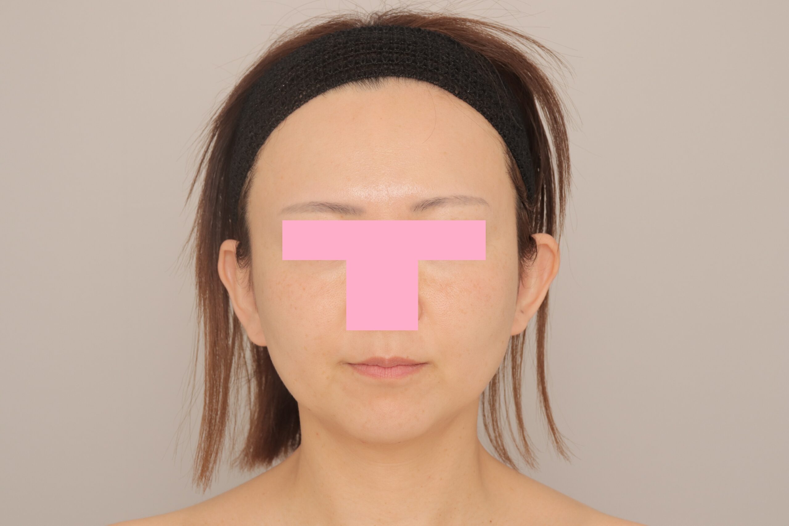 ベイザー脂肪吸引（3か月経過：43）の術前写真