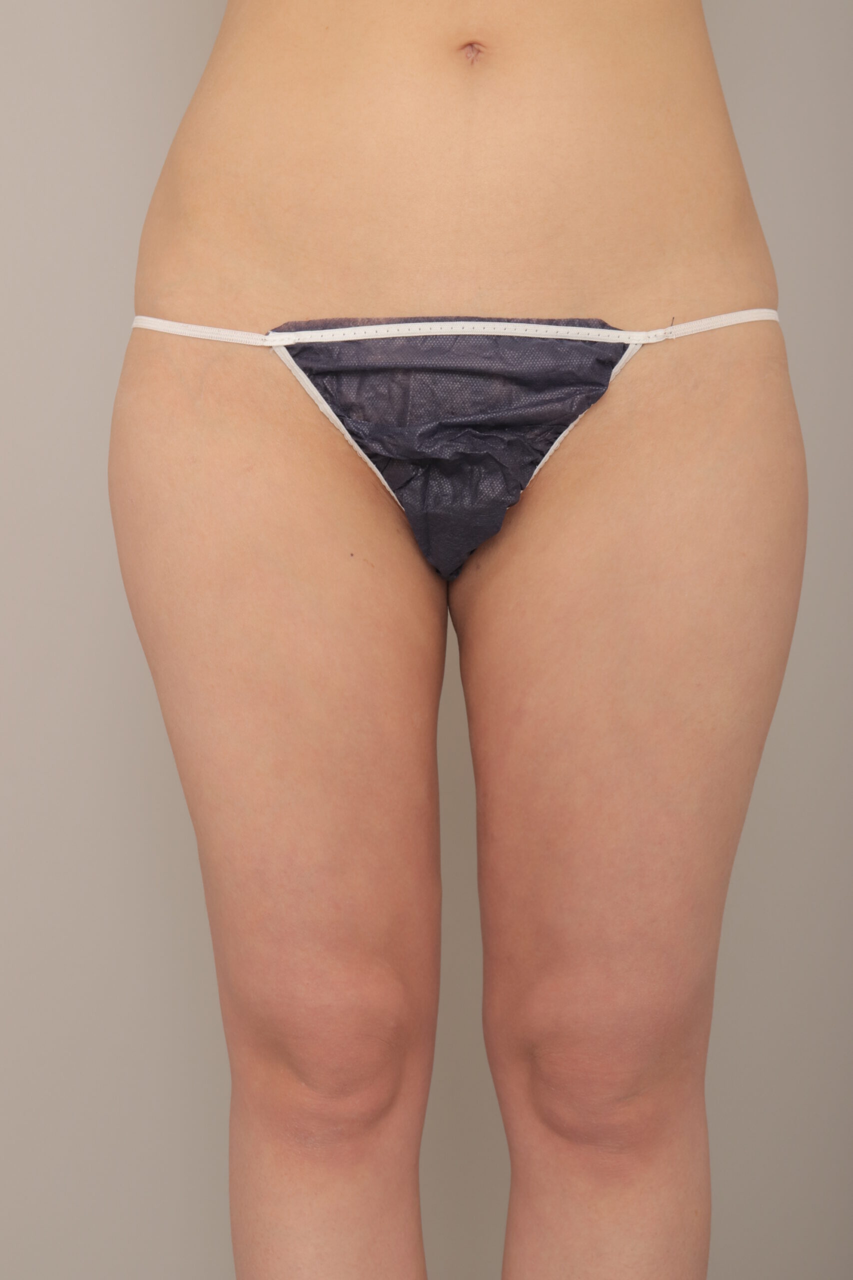 ベイザー脂肪吸引（3か月経過：22）の術後写真