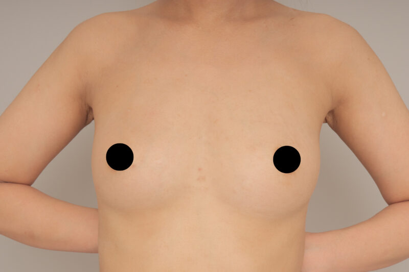 ベイザー脂肪吸引(3か月経過:22)の術後写真