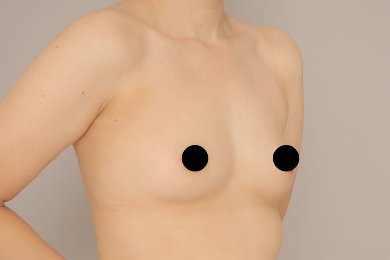 ベイザー脂肪吸引(1か月経過:34)の術前写真