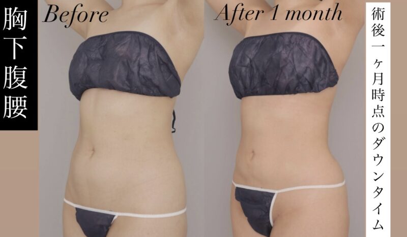 【骨格ストレート×胸下腹腰の吸引】1か月時点のダウンタイムの様子