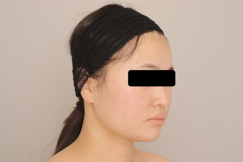 ベイザー脂肪吸引（３か月経過：21）の術前写真