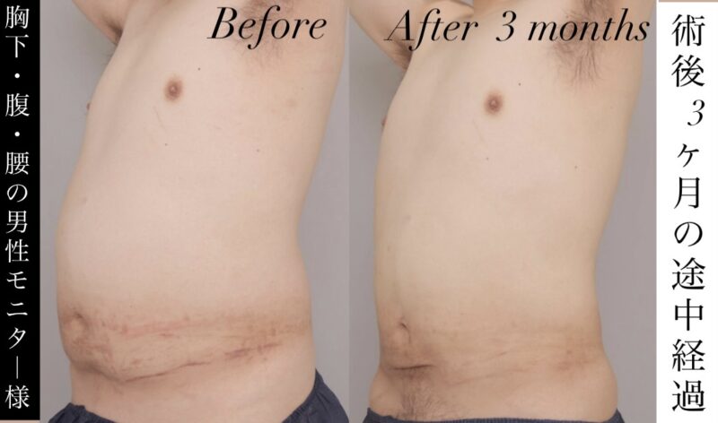 【腹部全体＋胸下＋腰部】男性モニター様の術後3か月時点での途中経過です