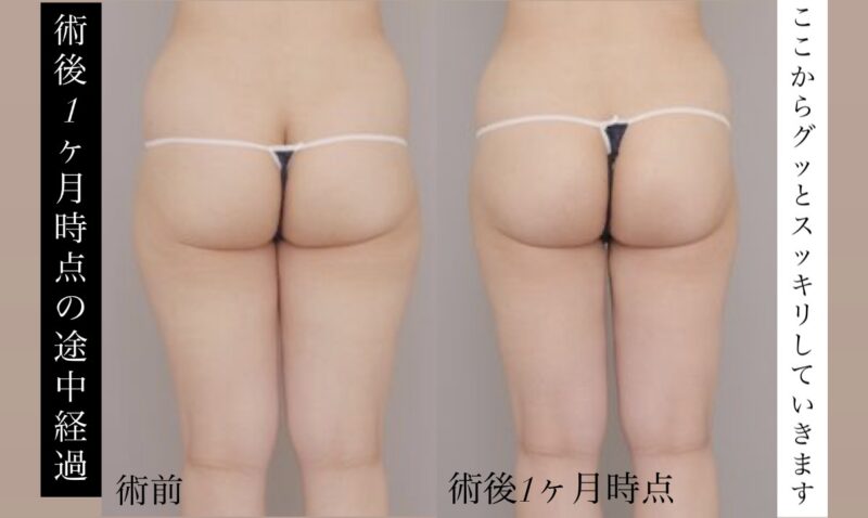 【術後1か月時点の途中経過】太腿全周+臀部膝＋臀部