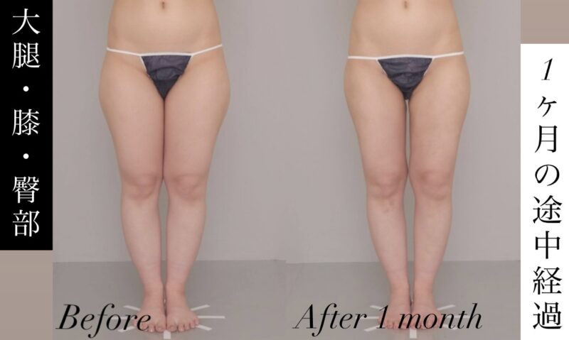 【《大腿＋膝内側＋臀部》 1か月の途中経過】すでに外張り・内もも・前張りがスッキリ！