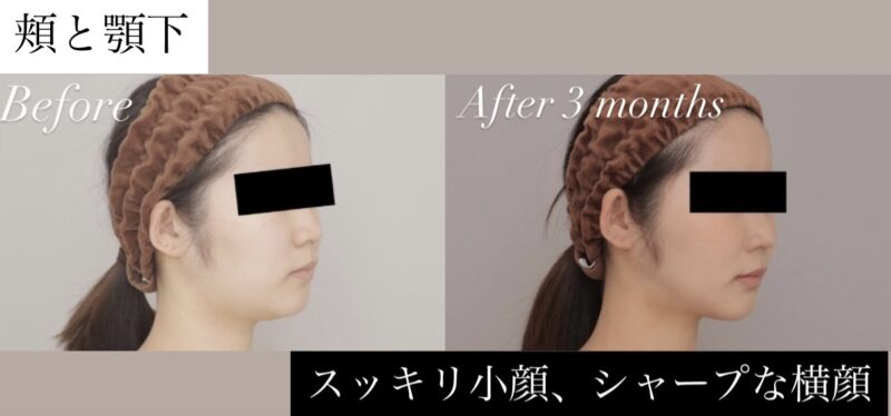 頬・顎下の脂肪吸引で叶える！すっきり小顔＆シャープな横顔