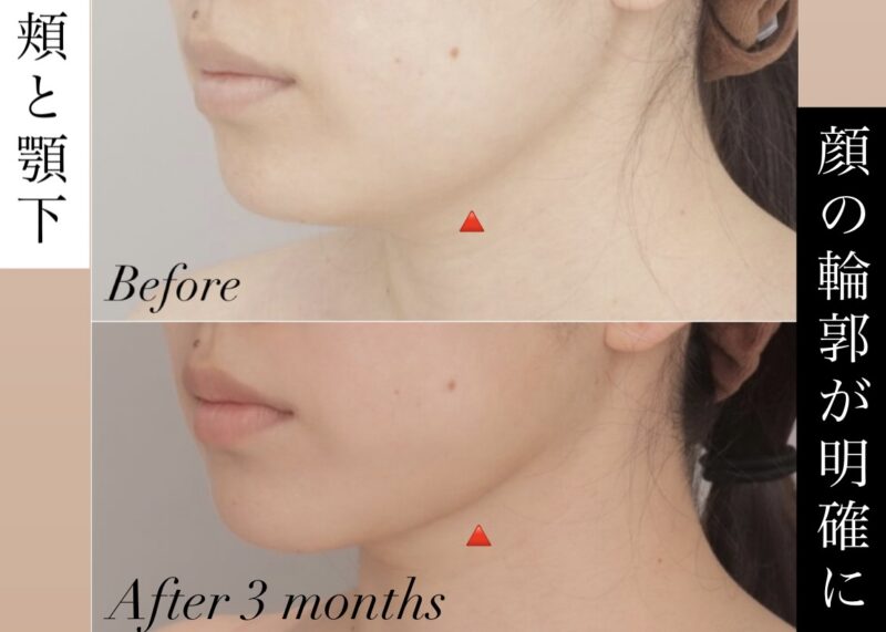 【術後3か月の経過】顔の輪郭が明確になり、より美しいバランスに！