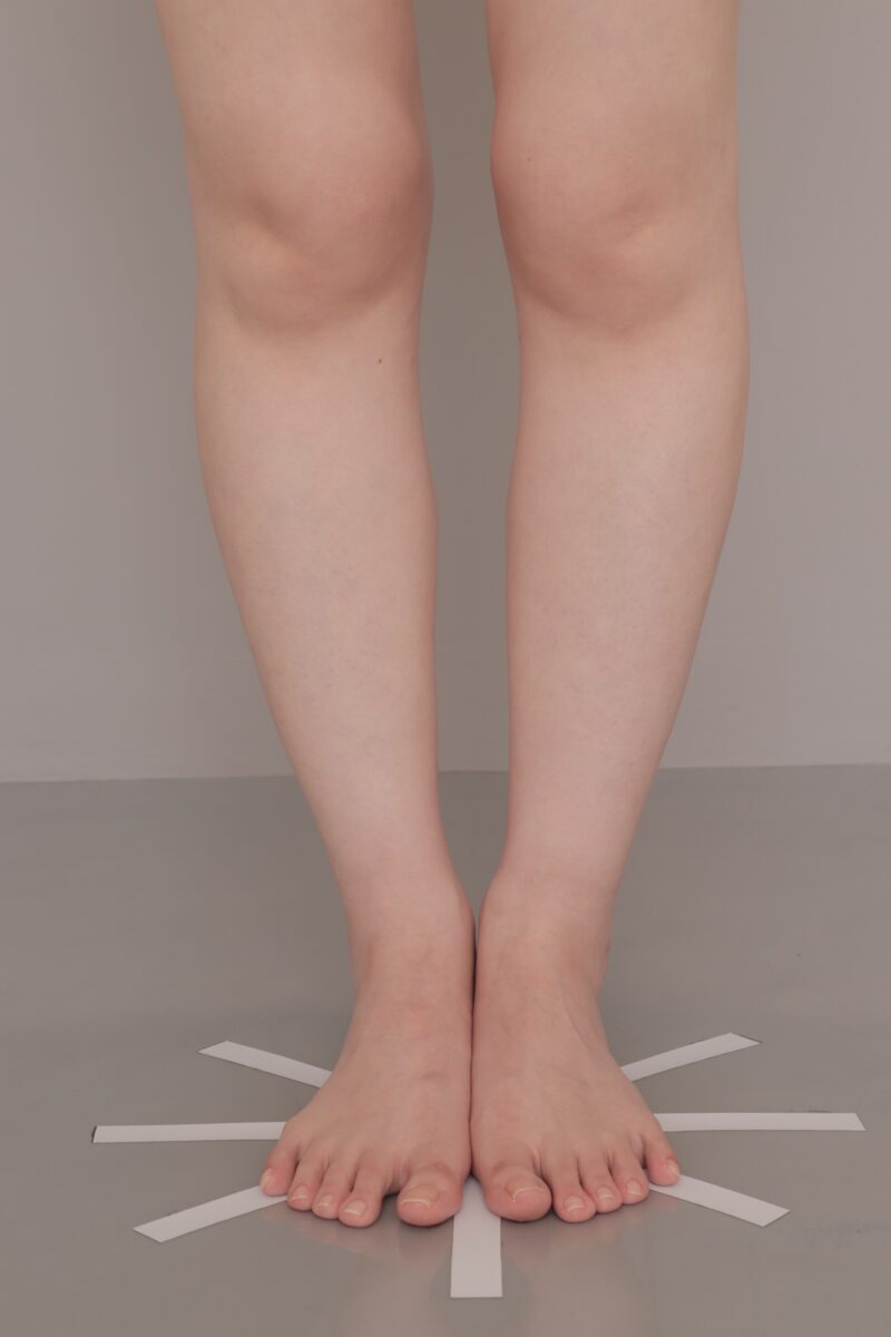 ベイザー脂肪吸引（6ヶ月経過：29）の術後写真