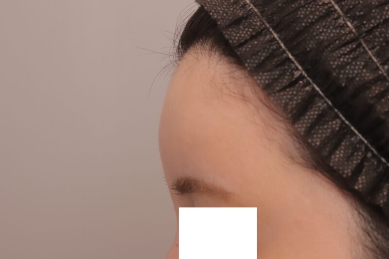 ベイザー脂肪吸引（1ヶ月経過：29）の術後写真