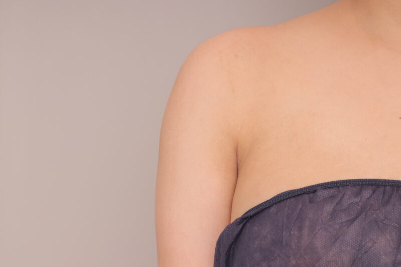 ベイザー脂肪吸引（３ヶ月経過：33）の術前写真