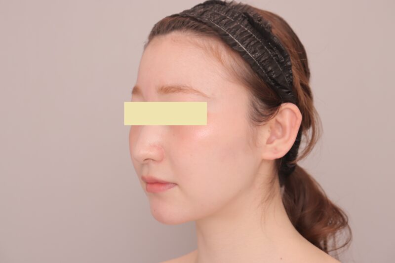 ベイザー脂肪吸引（３ヶ月経過：27）の術後写真