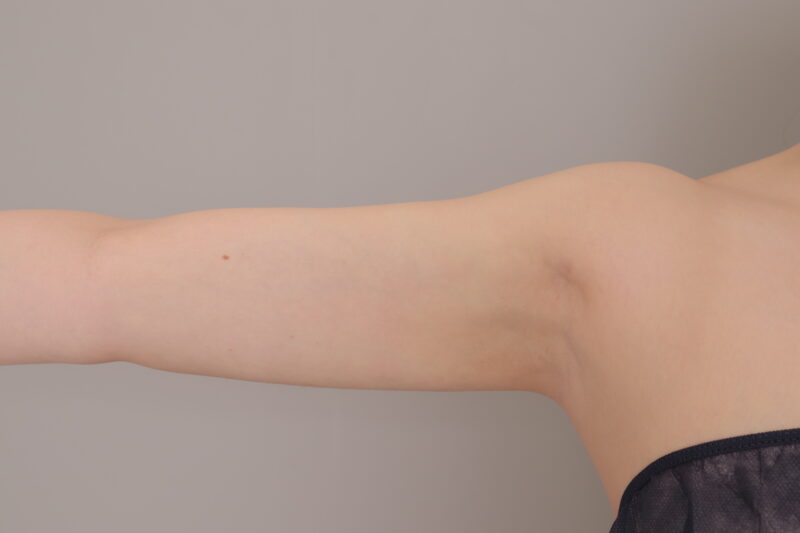 ベイザー脂肪吸引(3ヶ月経過:26)の術後写真