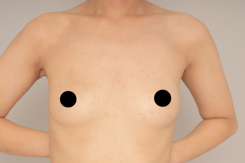 ベイザー脂肪吸引(3か月経過:22)の術前写真