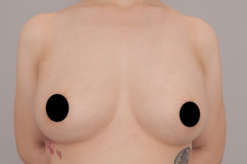 ベイザー脂肪吸引（1ヶ月経過：34）の術後写真