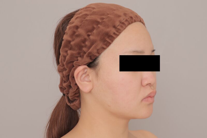 ベイザー脂肪吸引（3ヶ月経過：24）の術後写真