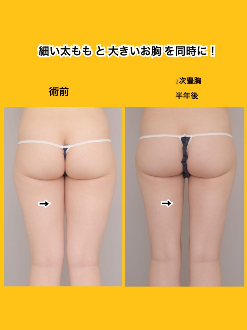 太ももの細さと、お胸の大きさを同時に。 ～23歳156cm50kg脂肪豊胸（CRFバスト）太もも全周膝臀部吸引、2次豊胸後半年～