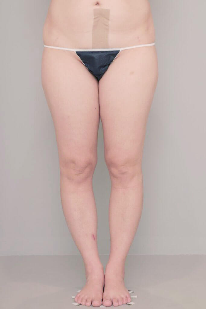 術前