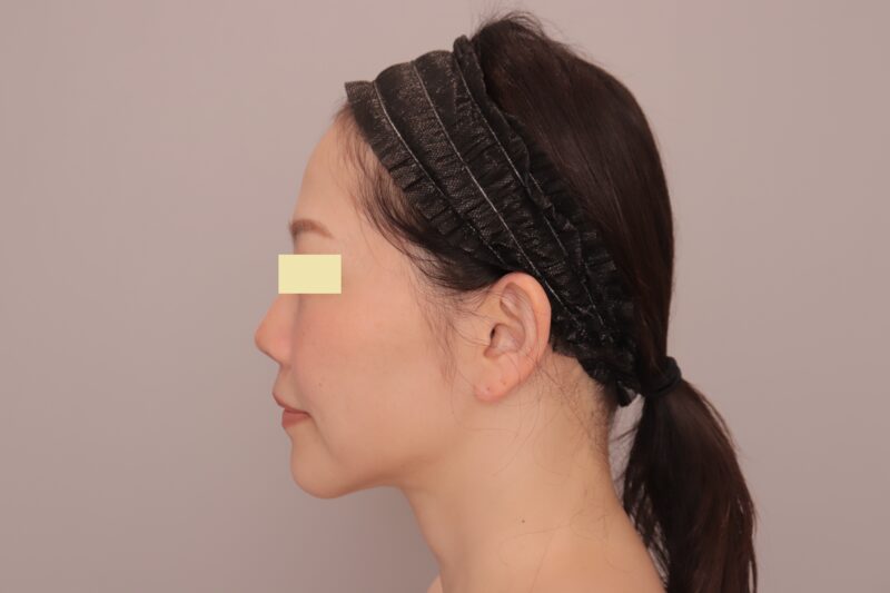 ベイザー脂肪吸引（半年経過：45）の術後写真