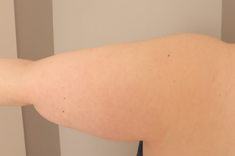 ベイザー脂肪吸引（半年経過：41）の術前写真