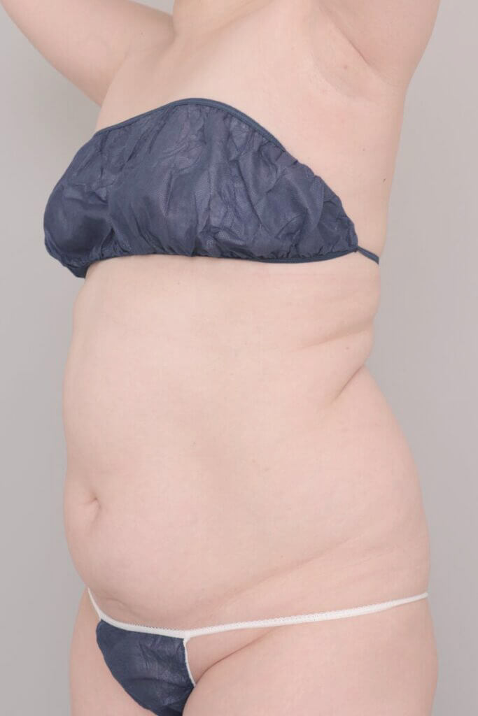 術前