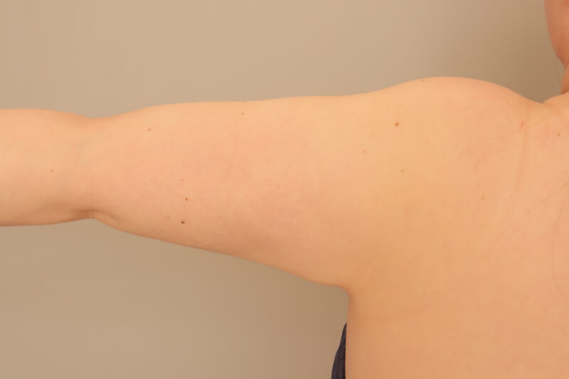 ベイザー脂肪吸引（半年経過：41）の術後写真