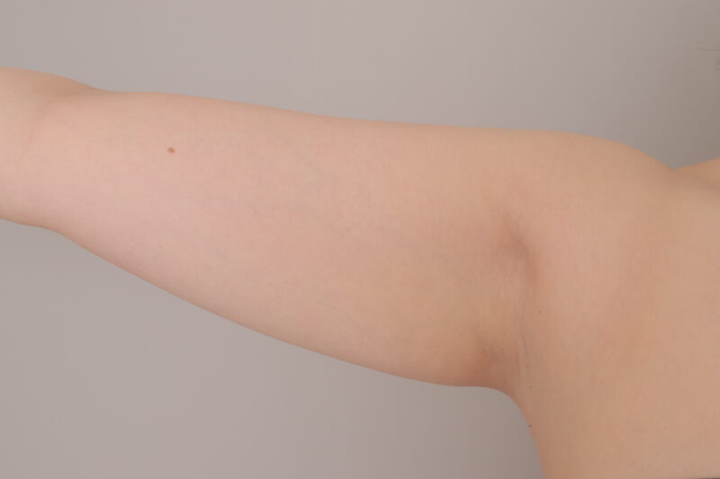 ベイザー脂肪吸引(3ヶ月経過:26)の術前写真