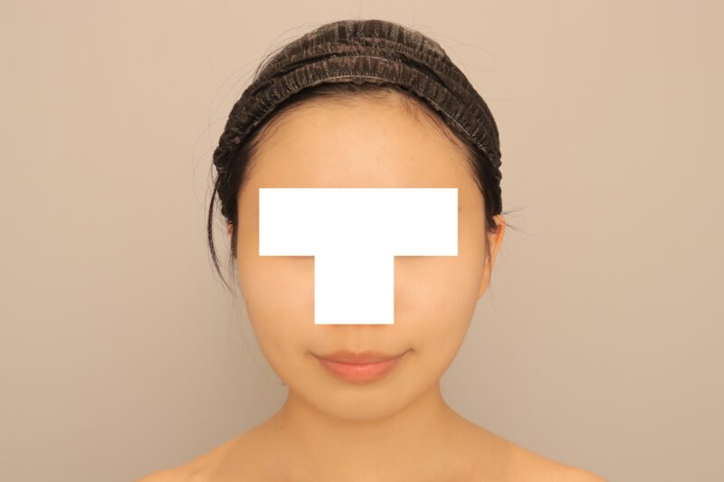 ベイザー脂肪吸引（半年経過：19）の術後写真