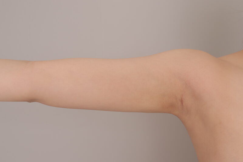 ベイザー脂肪吸引（1ヶ月経過：20）の術後写真