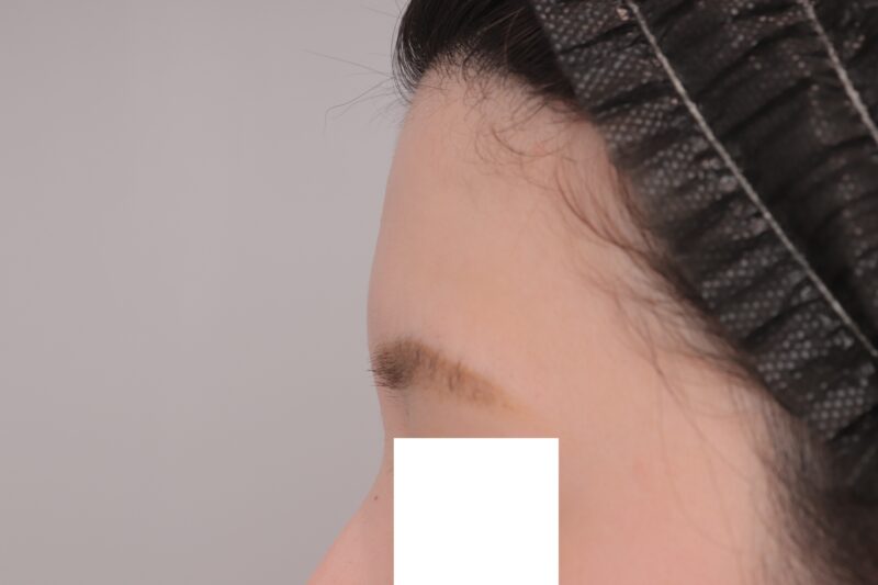 ベイザー脂肪吸引（1ヶ月経過：29）の術前写真