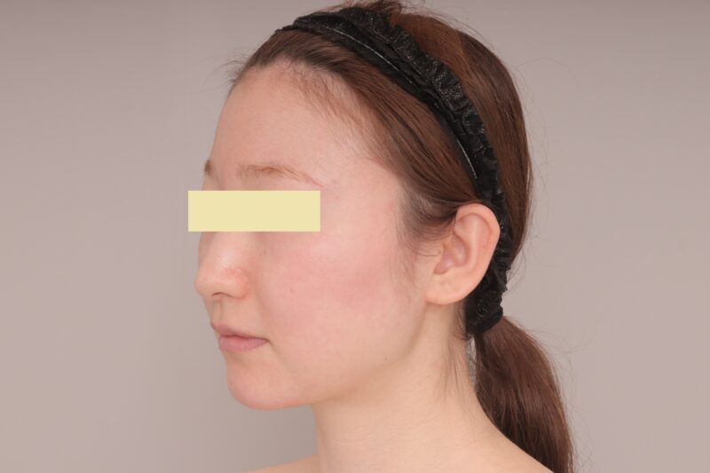 ベイザー脂肪吸引（３ヶ月経過：27）の術前写真