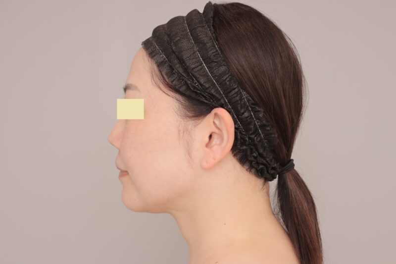 ベイザー脂肪吸引（半年経過：45）の術前写真