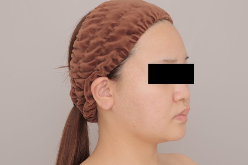 ベイザー脂肪吸引（3ヶ月経過：24）の術前写真