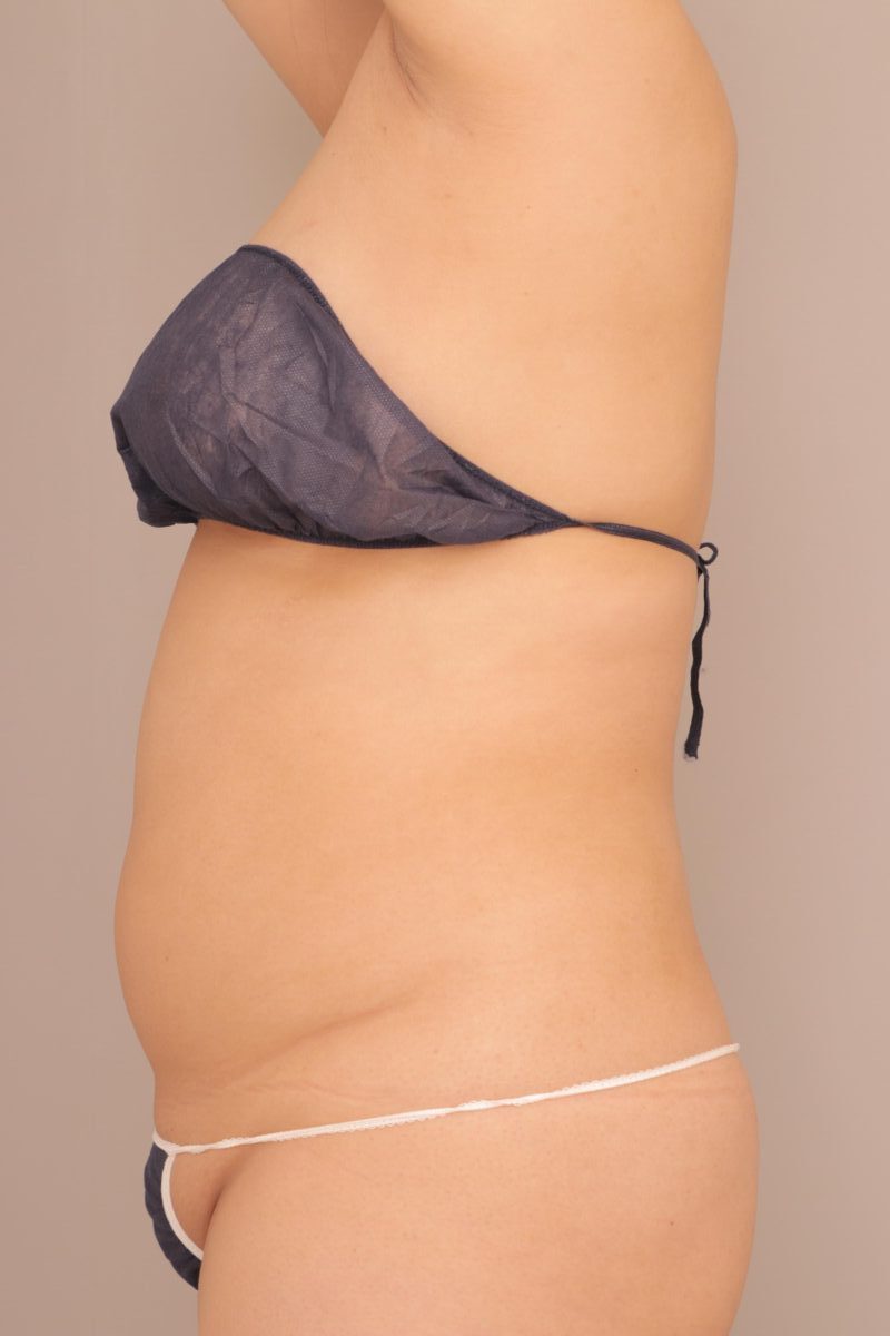 ベイザー脂肪吸引（半年経過：33）の術前写真