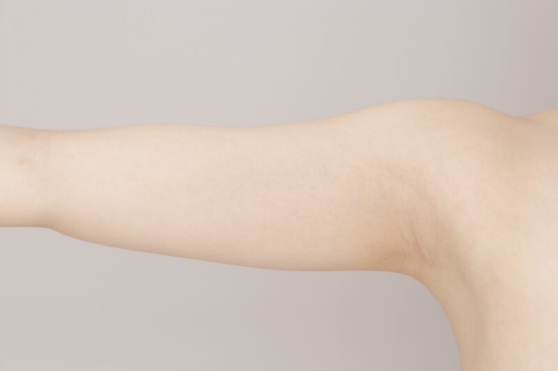 ベイザー脂肪吸引（1ヶ月経過：20）の術前写真