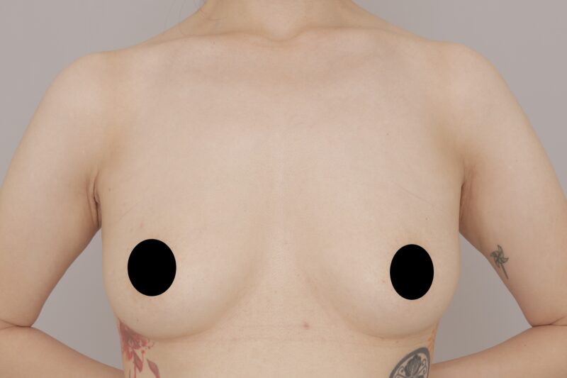 ベイザー脂肪吸引（1ヶ月経過：34）の術前写真