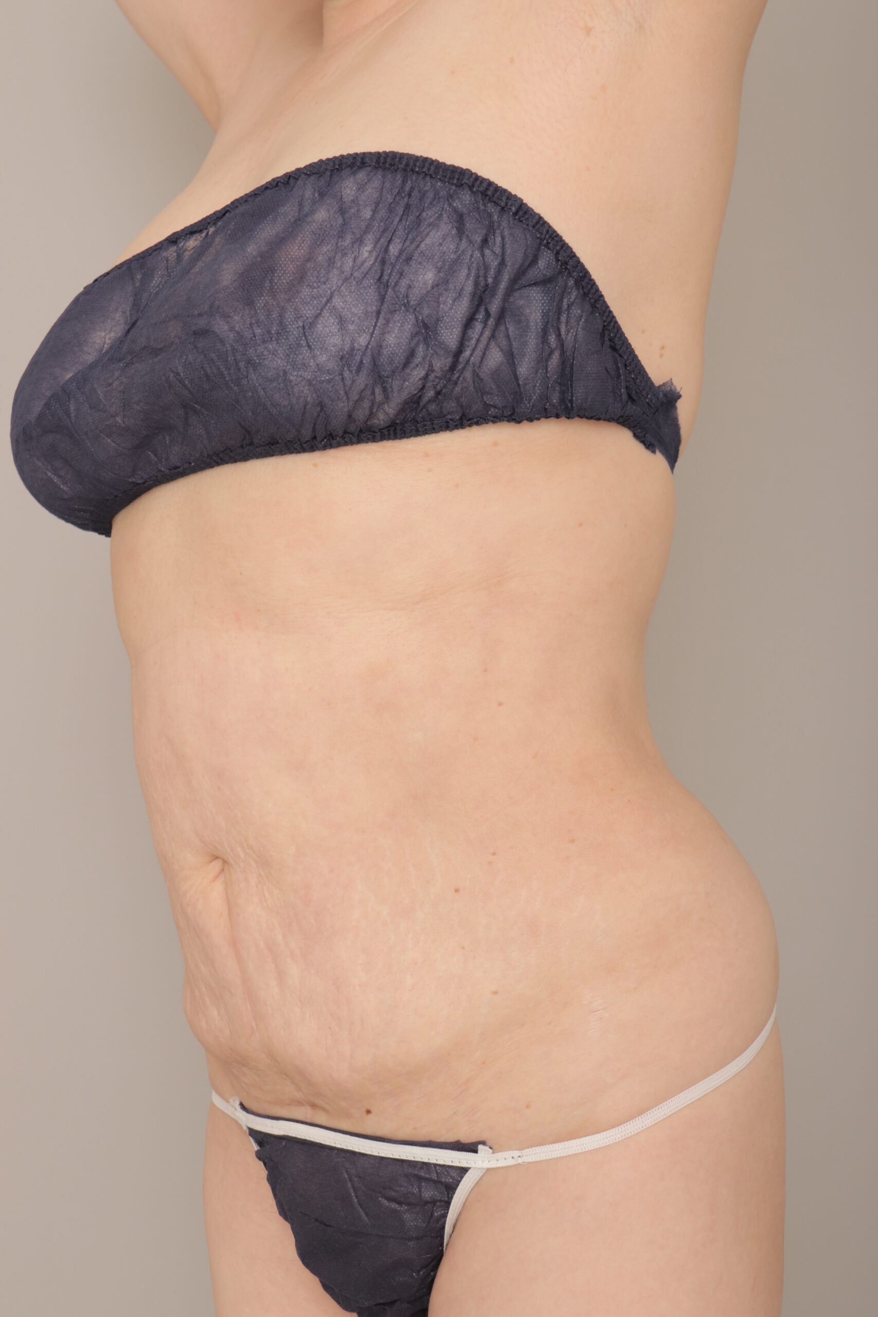 ベイザー脂肪吸引（６か月経過：57）の術後写真