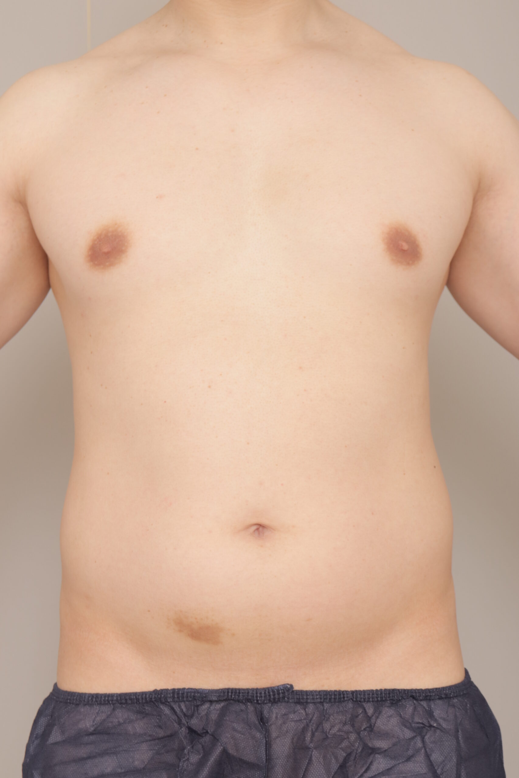 ベイザー脂肪吸引(1ヶ月経過:38)の術前写真