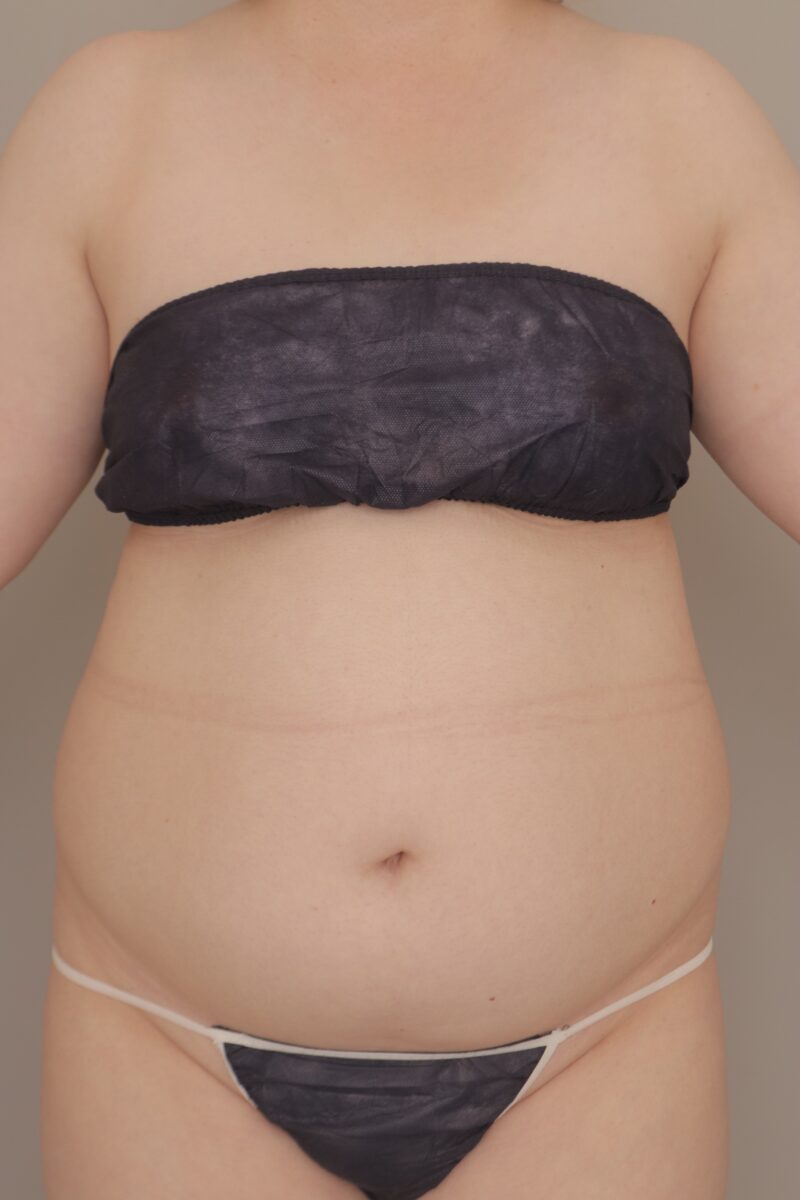 ベイザー脂肪吸引（半年経過：47）の術前写真