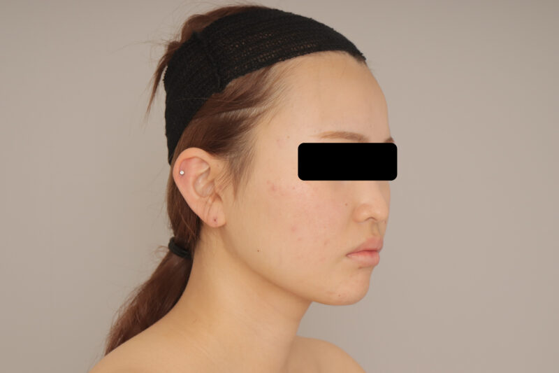 頬・顎下脂肪吸引３か月経過のご紹介です。