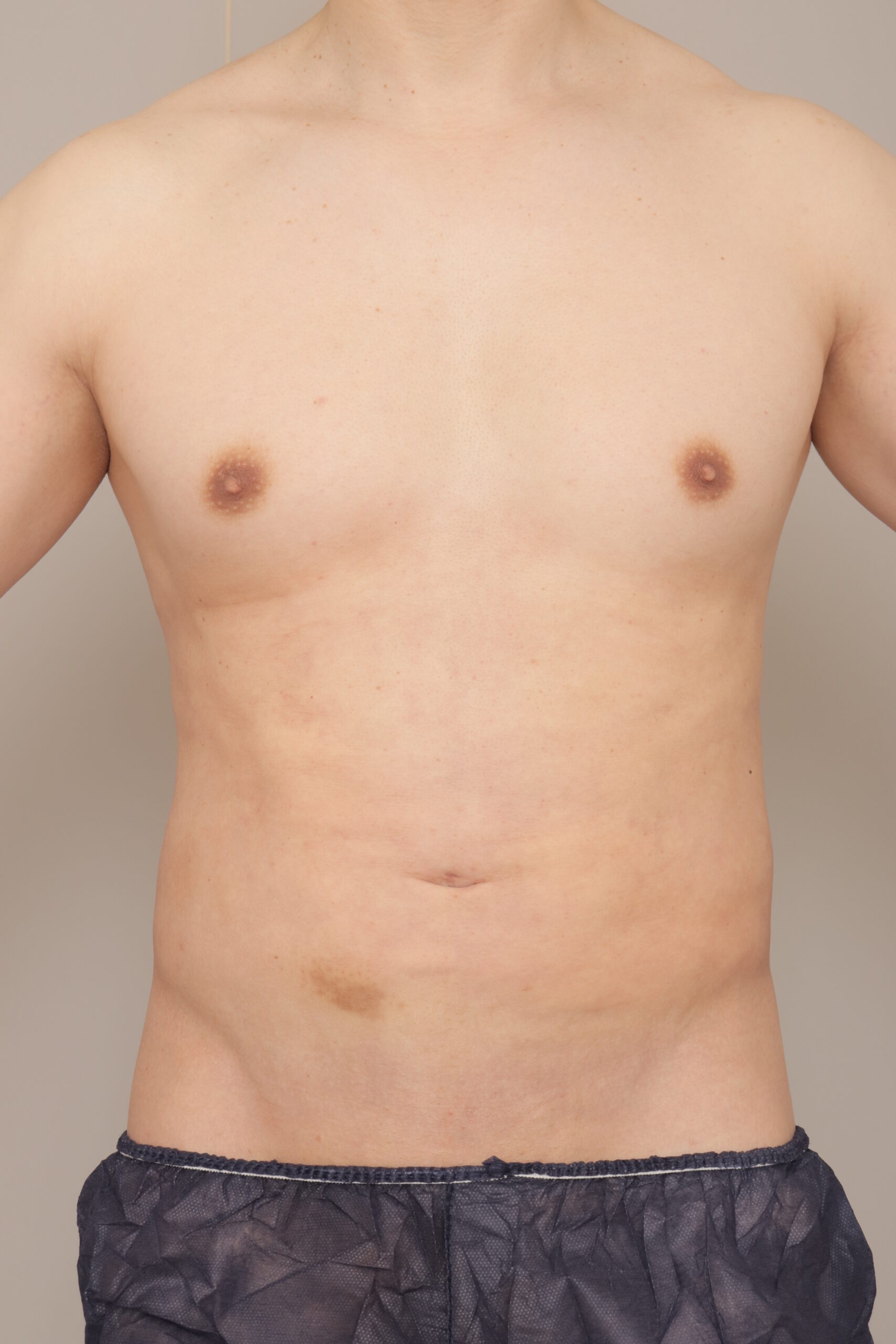 ベイザー脂肪吸引(1ヶ月経過:38)の術後写真