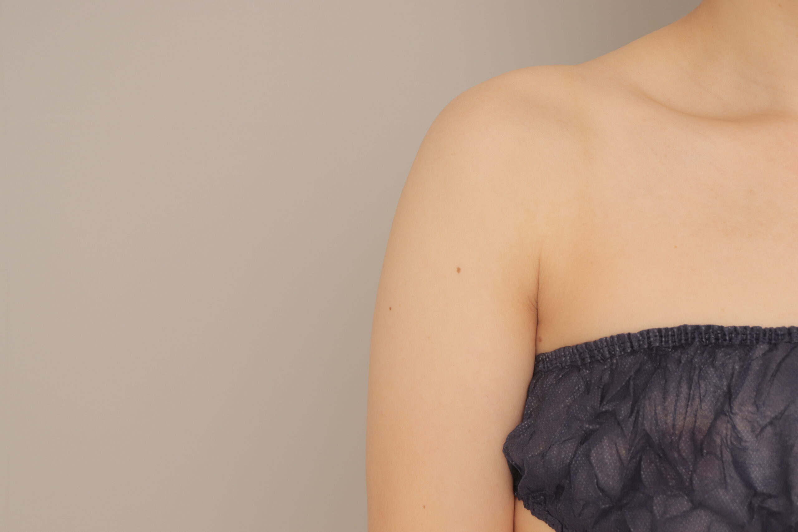 ベイザー脂肪吸引(1か月経過:34)の術前写真