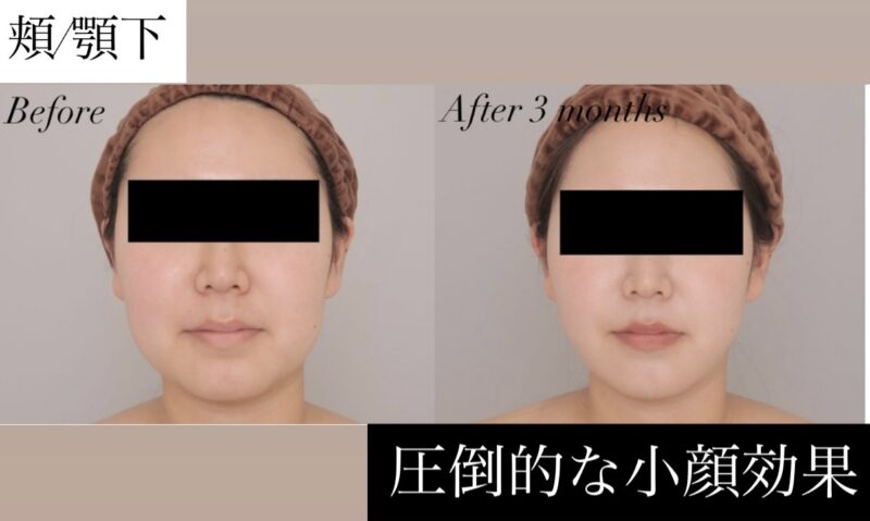 【圧倒的な小顔効果】すっきりとしたVラインの形成