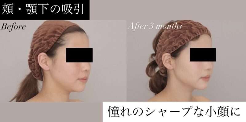 【頬＋顎下】憧れの小顔＆シャープな横顔を手に入れる