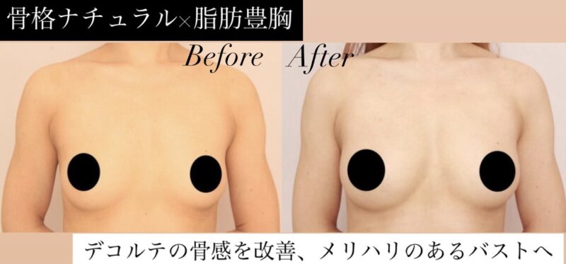 【骨格ナチュラル×脂肪豊胸】デコルテからふっくら広がる、お椀型の美しい輪郭へ！