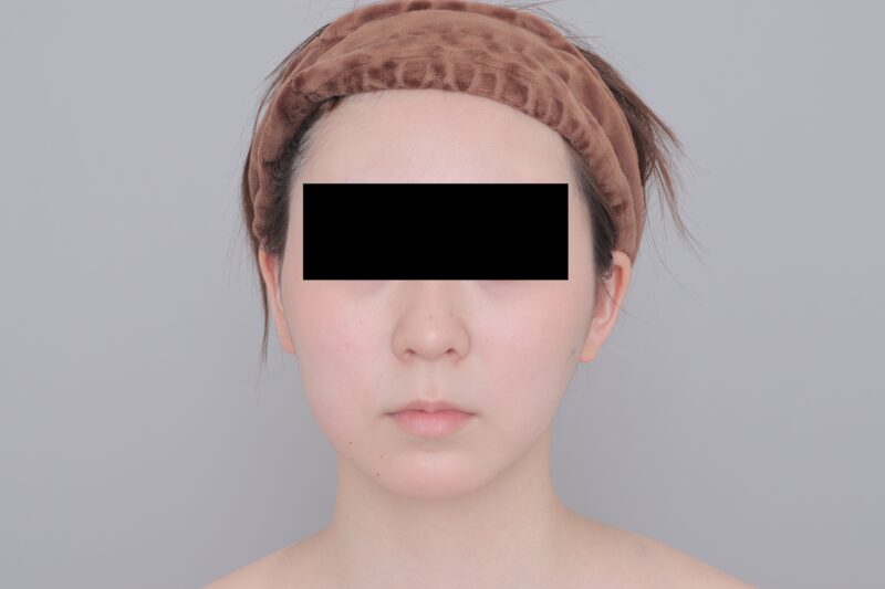 ベイザー脂肪吸引（3ヶ月経過：19）の術後写真