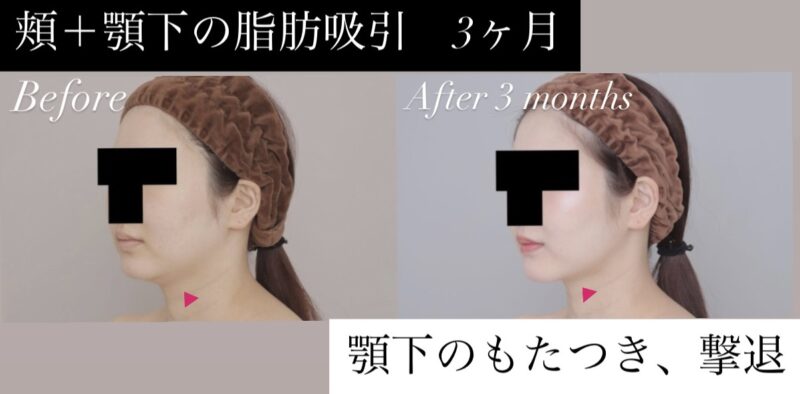 【Question】フェイスラインをスッキリさせるには顔のどの部分を脂肪吸引すればいいの?