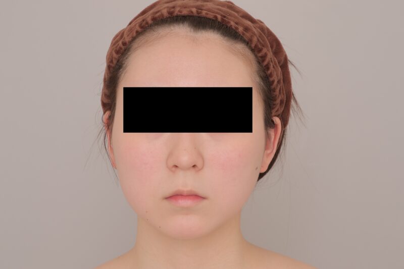 ベイザー脂肪吸引（3ヶ月経過：19）の術前写真