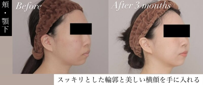 【別人級の小顔に！】スッキリとした輪郭と美しい横顔を手に入れる