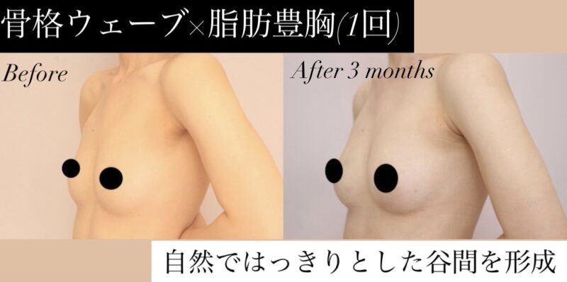 【Question】シリコン豊胸と比較した際の脂肪豊胸のメリットは何?